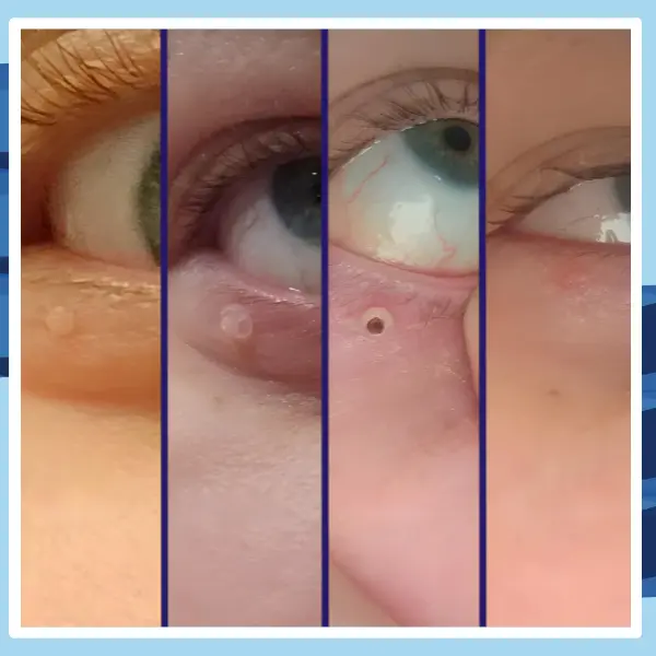 Bőrkinövés Eltávolító Készlet NUVAI