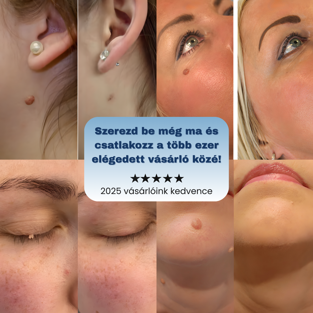 Bőrkinövés Eltávolító Készlet NUVAI