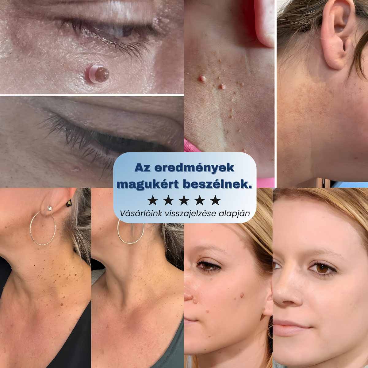 Bőrkinövés Eltávolító Készlet NUVAI