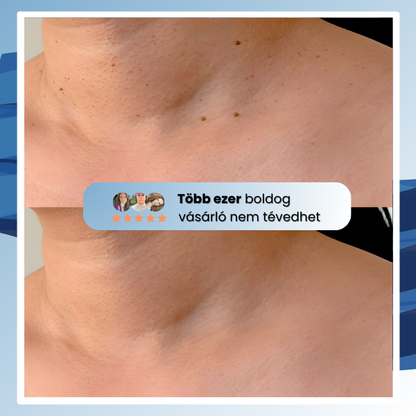 Bőrkinövés Eltávolító Készlet NUVAI