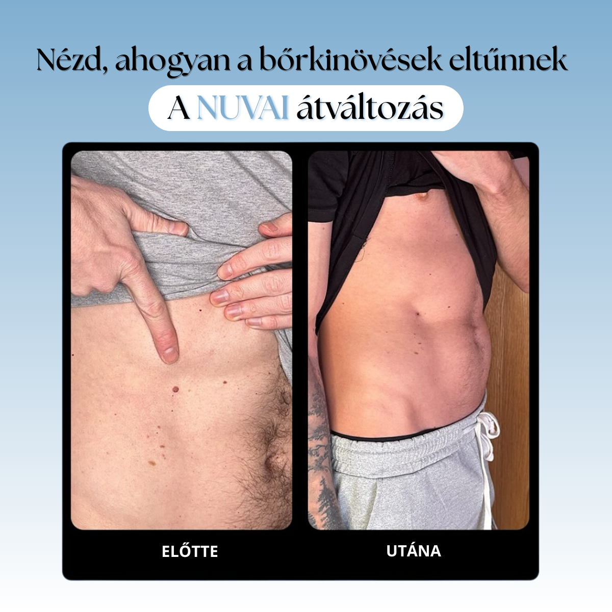 Bőrkinövés Eltávolító Készlet NUVAI