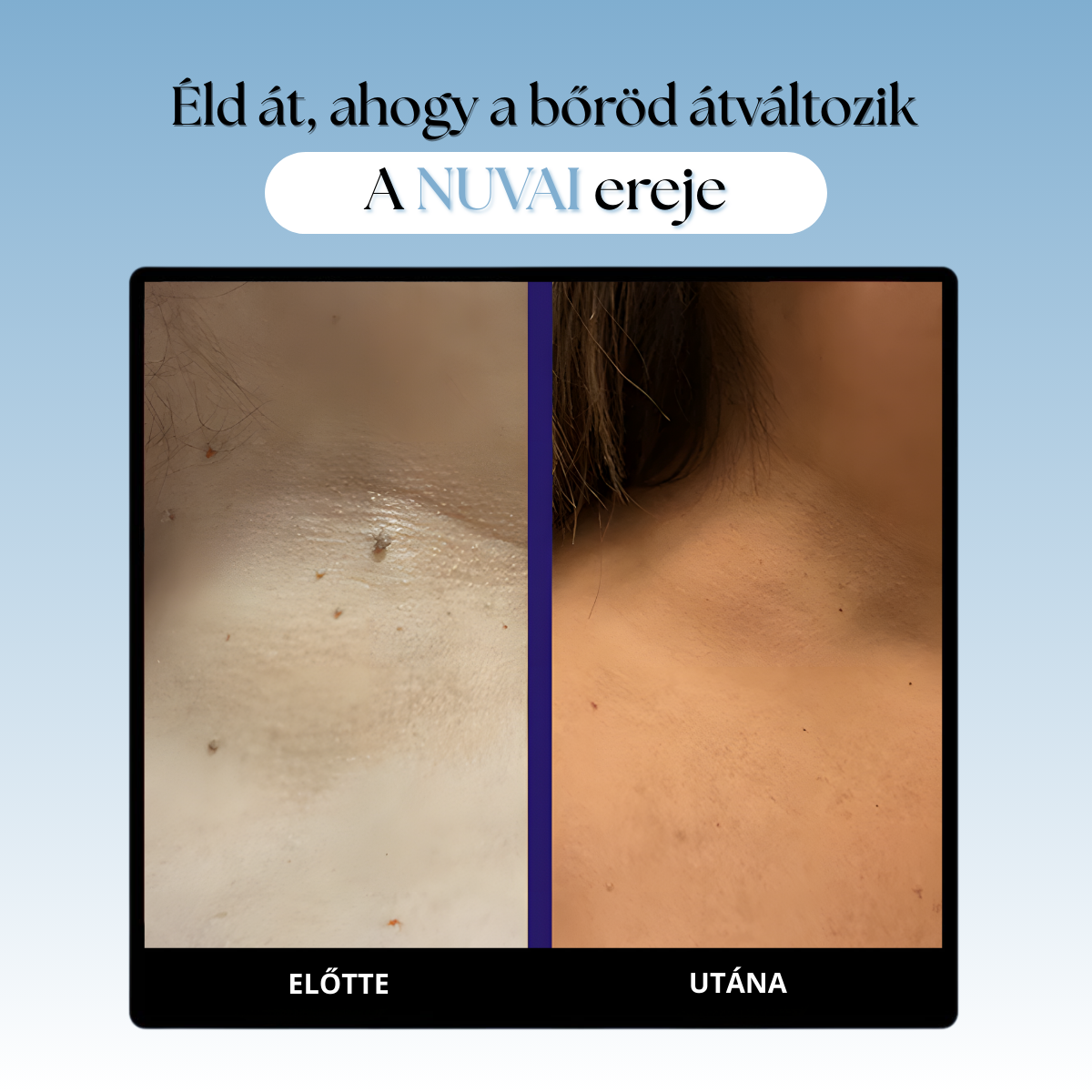 Bőrkinövés Eltávolító Készlet NUVAI