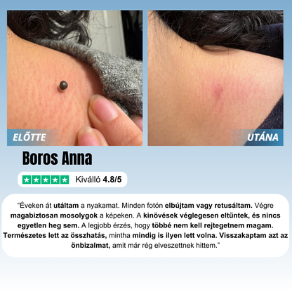 Bőrkinövés Eltávolító Készlet