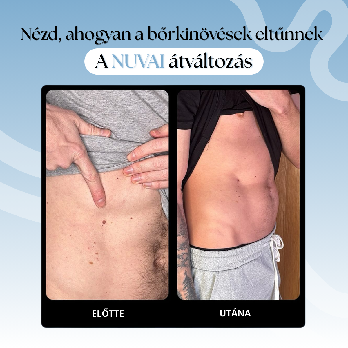 Bőrkinövés Eltávolító Készlet NUVAI