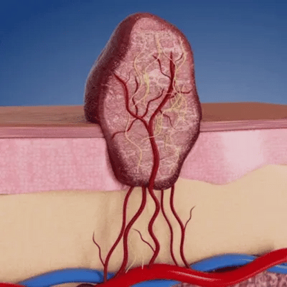 Bőrkinövés Eltávolító Készlet NUVAI