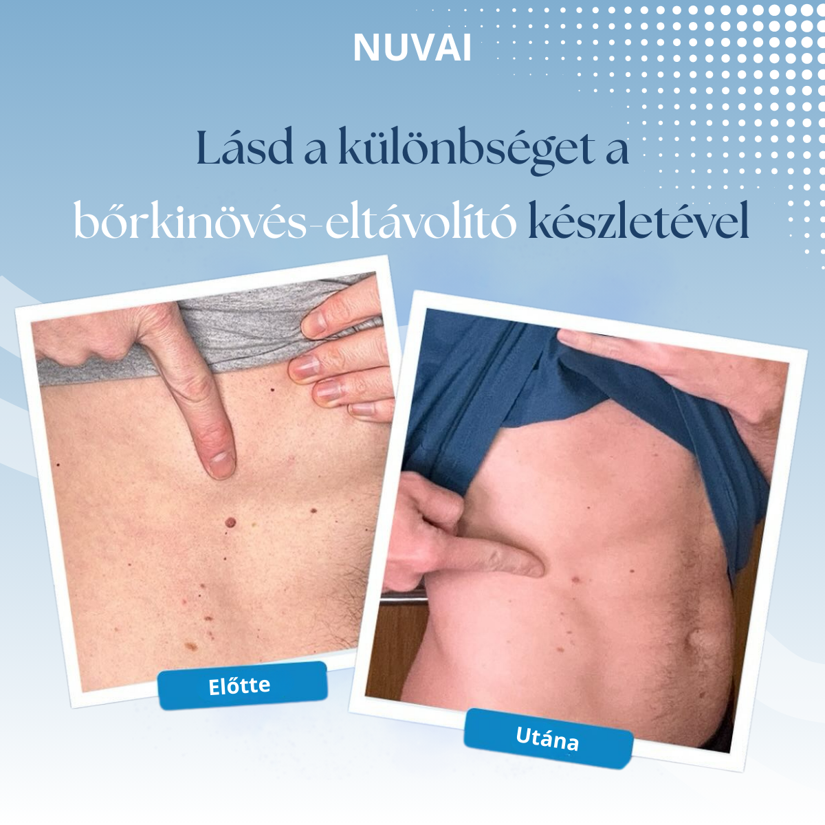 Bőrkinövés Eltávolító Készlet NUVAI
